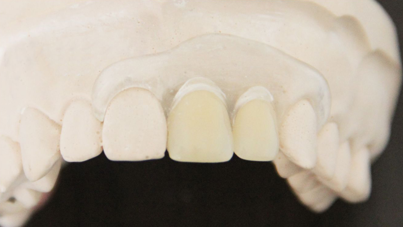 xlm-hc 规格:美国透明隐形义齿    "适用范围"定制式活动义齿适用于牙